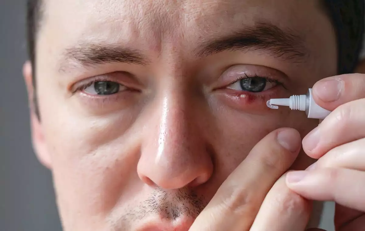 بهترین پماد چشمی برای گل مژه چشم کدام است؟